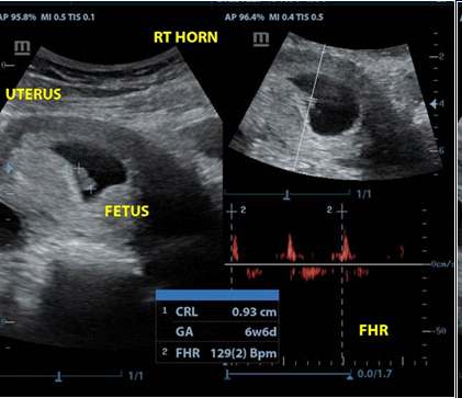 Figure 1: Gestational sac with a live foetus with a heart rate of 129 beats per minute