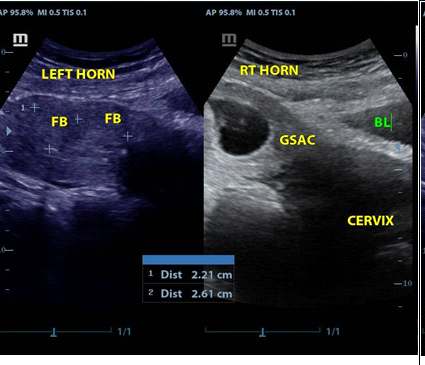 Figure 2: Myometrial solid masses in the left horn of the uterus with gestation sac in the right horn