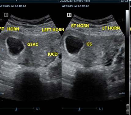 Figure 3: Both horns showing a gestational sac in the right and an IUCD in the left.