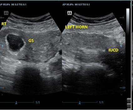 Figure 4: IUCD noted in situ in the left endometrial cavity and a gestation sac in the right horn.