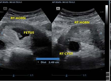 Figure 5: A well-defined anechoic mass in the left ovary consistent with a corpus luteal cyst and a corresponding intrauterine gestational sac and foetus.