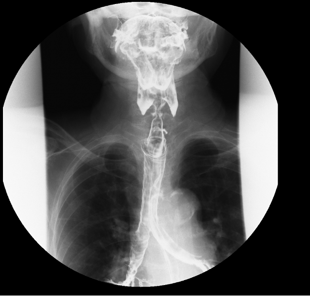 Figure 1: Image showing aspiration of barium in the trachea (smaller arrow) and pooling of barium in the valleculae and pyriform fossae (bigger arrow).