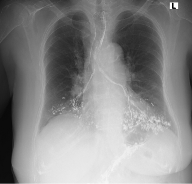 Figure 2: Post physiotherapy chest image showing a significant amount of barium in the tracheobronchial tree.