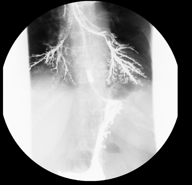 Figure 3: Image shows a significant amount of barium in the tracheobronchial tree. Arrow shows poor distension of the proximal third of the thoracic oesophagus.