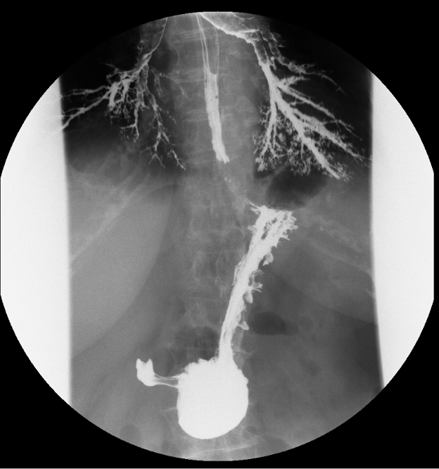Image showing pooling of barium in the stomach. Big arrow shows a smooth outline of the distal oesophagus with no evidence of distension. Smaller arrow shows collapsed stomach.