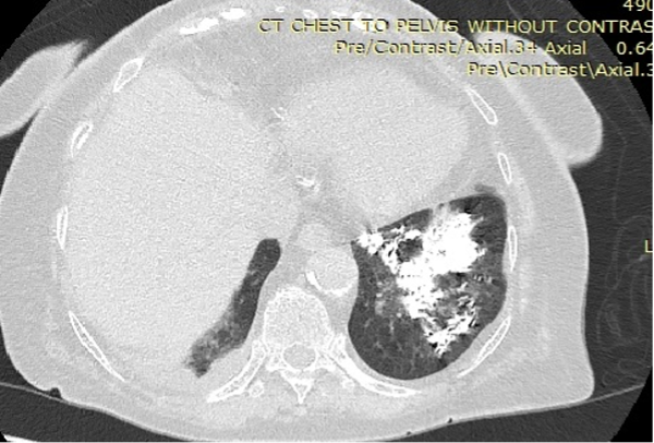 Axial CT image showing aspirated Barium in the left lower lung