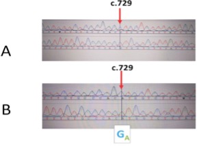 Figure 1: Mutation analysis of MYOC in 45 patients. MYO mutation c.729G>A.