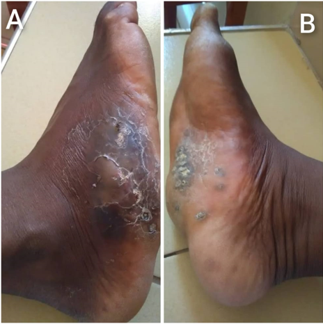 (A) obvious foot deformity and disfigurement associated with hyperpigmentation and scaling of the surrounding glabrous skin (B) several cornified plug punctate-like opening coalesced in the mid-section o plantar aspect of foot.