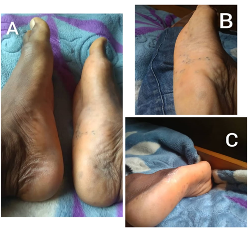Complete resolution of the deformity adter one year of treatment.