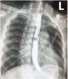 Barium swallow radiograph
