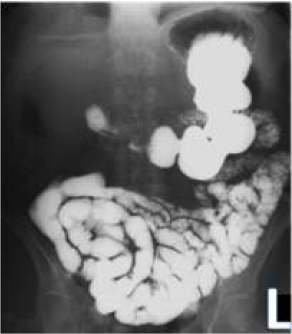 Small bowel follow-through (SBFT)radiograph