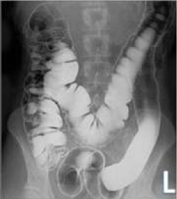 Barium enema radiograph