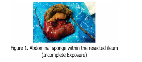 Abdominal sponge within the resected ileum(Incomplete Exposure)