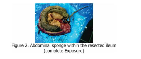 Abdominal sponge within the resected ileum(Complete Exposure)