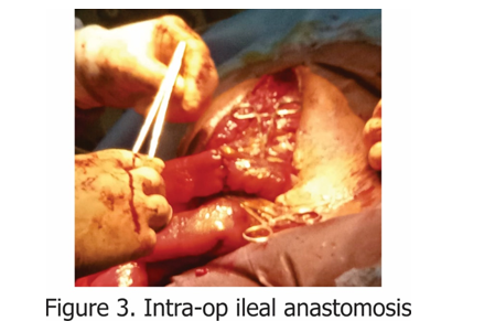 Intra-op ileal anastomosis