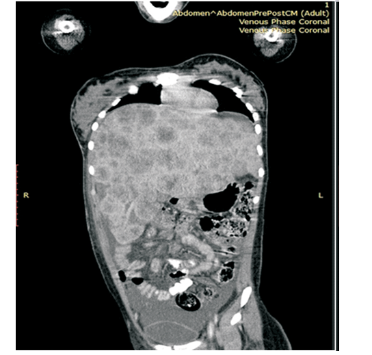 CT scan showing multiple masses in the liver.