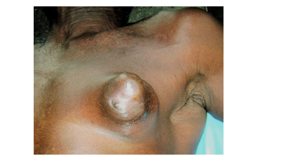 Left sided breast mass