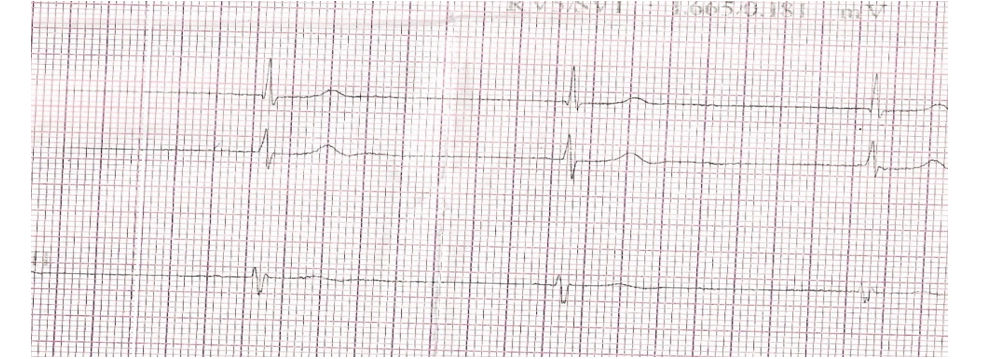 Electrocardiogram showing significant Bradycardia