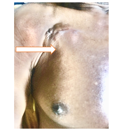 Transvenous pacemaker inserted right side of chest (white arrow)