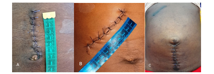  Mini-laparotomy incisions. A Upper midline approach (used for splenectomy); B Reduced-in-size Kocher incision (cholecystectomy); C Lower midline laparotomy; this patient was operated twice with the interval of 7 months; first, for acute cholecystitis, and later, for sigmoid volvulus with resection and primary anastomosis  