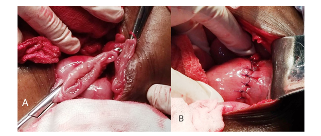 A Sigmoid volvulus resected through lower midline mini-laparotomy; B colorectal hand-sewn anastomosis 