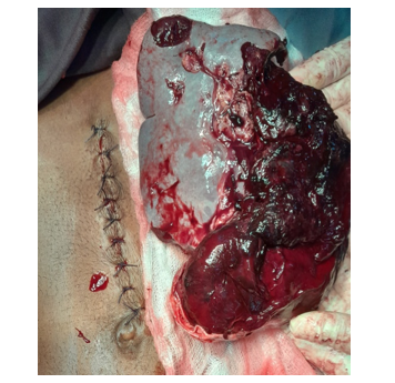 Splenectomy done through mini-laparotomy incision 