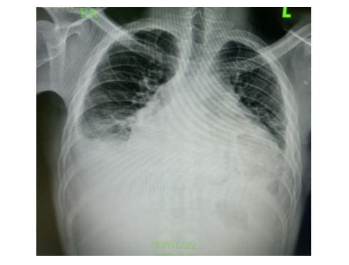 Pre-intervention AP Chest-Xray.