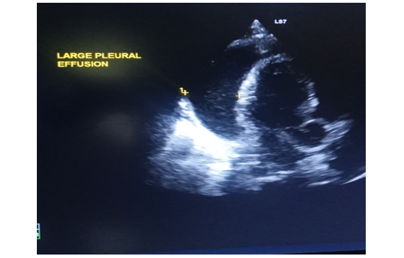 Pre-intervention Echocardiogram.