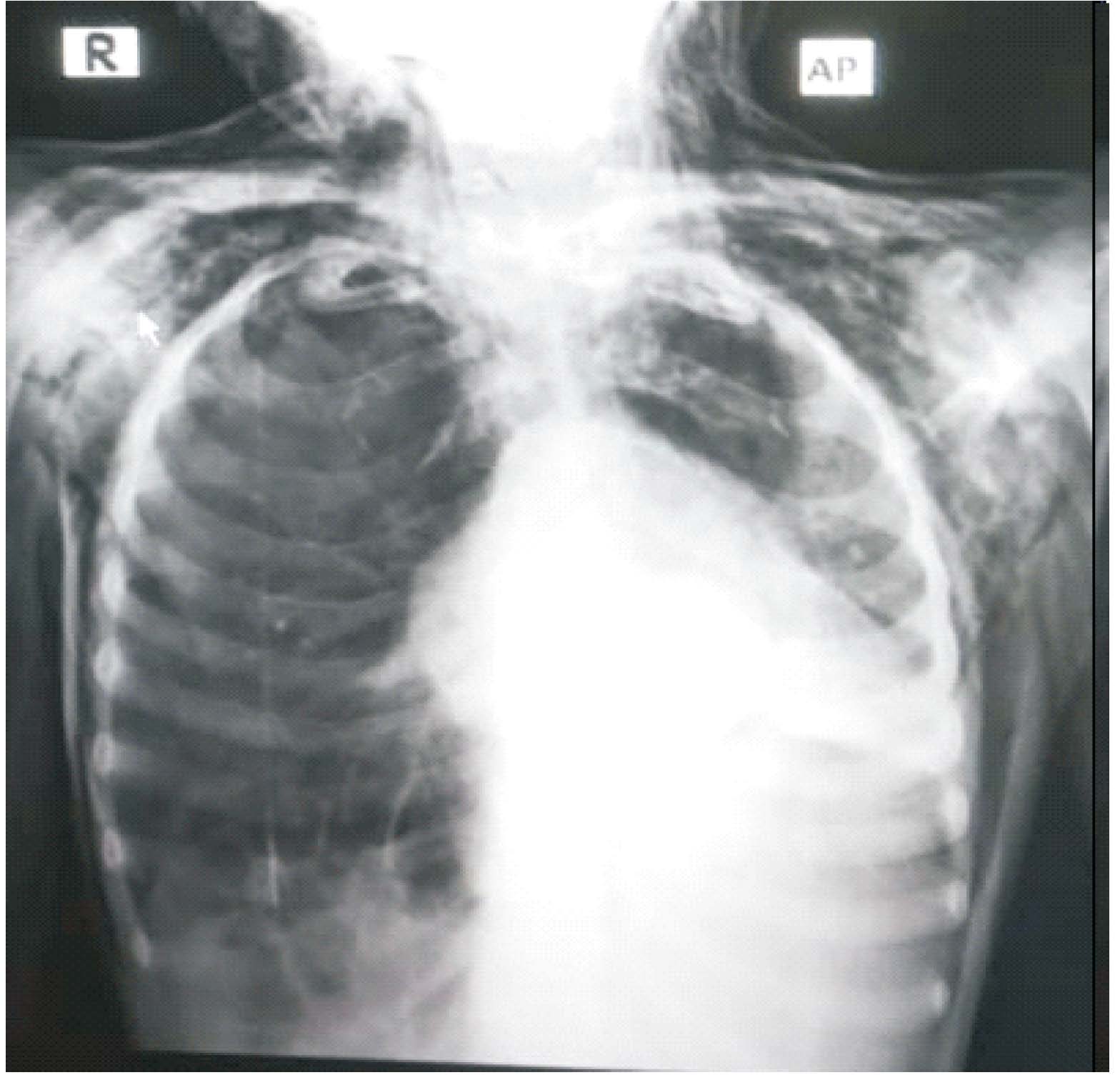 CXR performed at a primary hospital