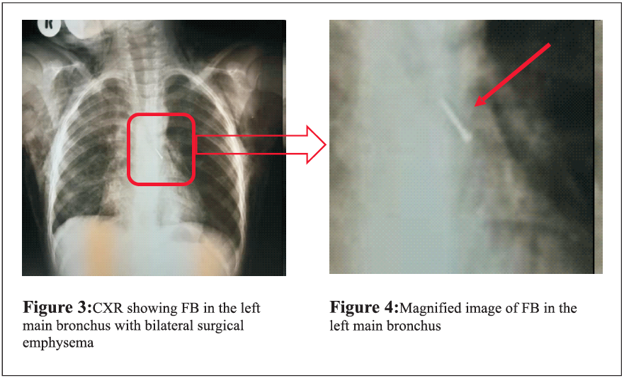 FB in the left main brochus