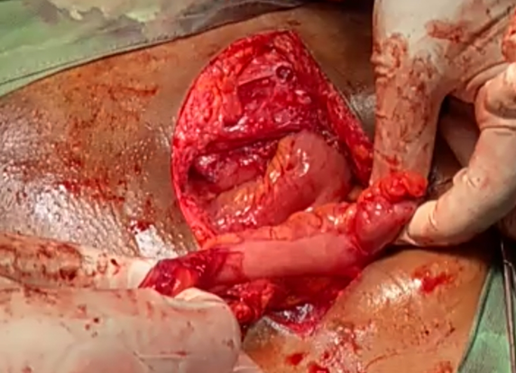 A segment of the sigmoid colon to be used as neovagina