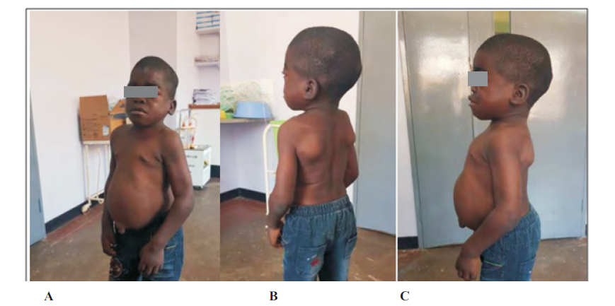 <strong>A)</strong>	Short stature with Course facies, protruding abdomen, and umbilical hernia.  <strong>B)</strong> Spinal lordosis. <strong>C)</strong> Macrocephaly, posteriorly rotated ears, protruding abdomen