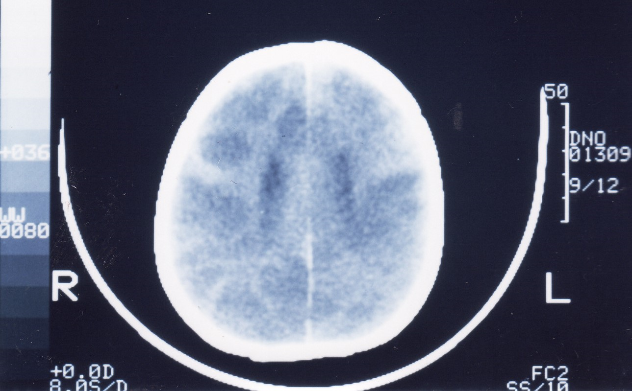 Macrograph of CT brain scan