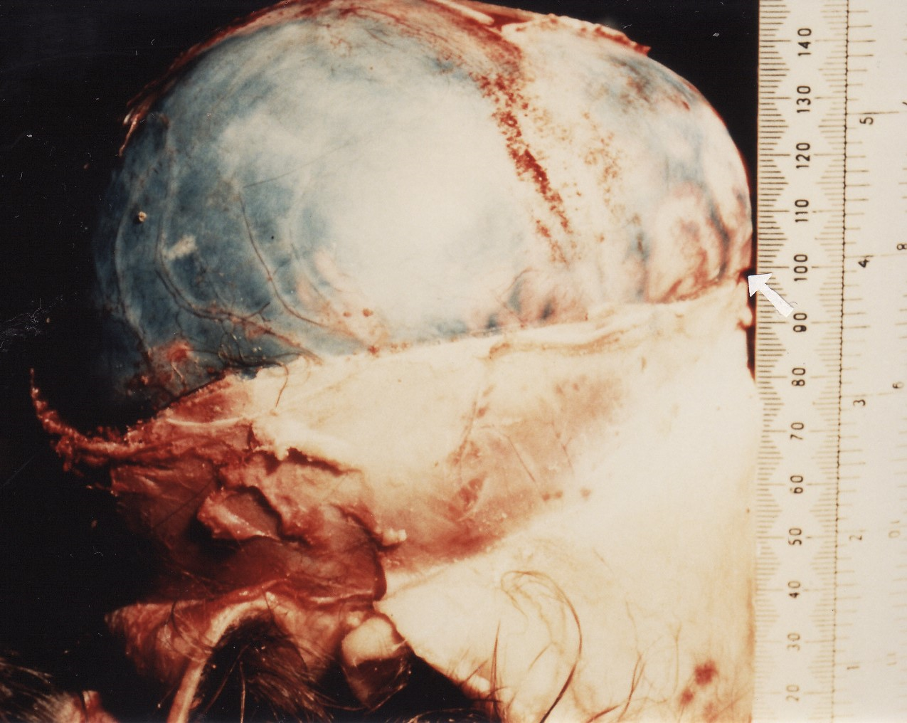 Fig 2 Subdural haematoma with cerebral overflow (arrowed) from intracranial pressure