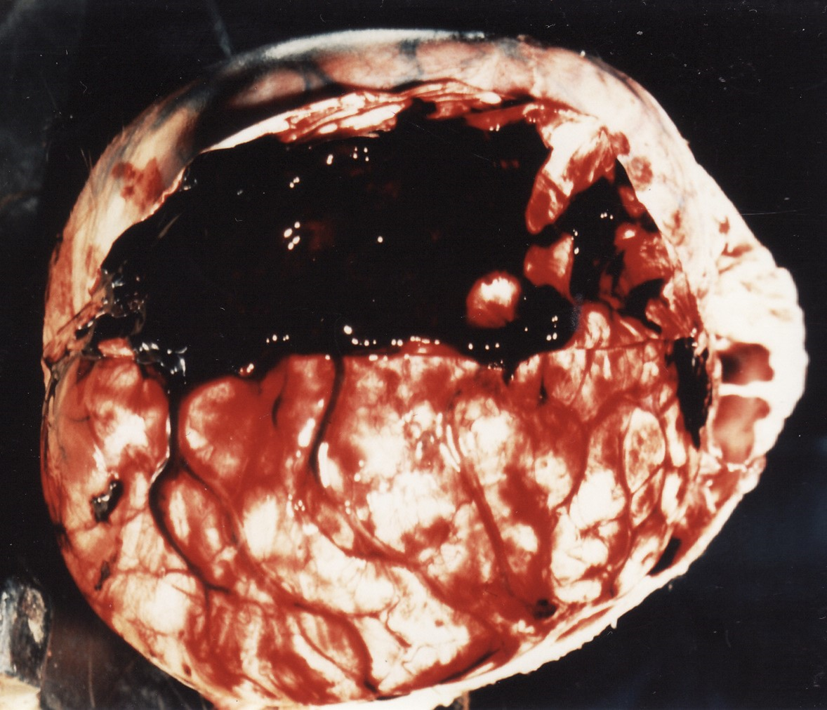 Fig. 3 Subdural haematoma adherent to dural flap