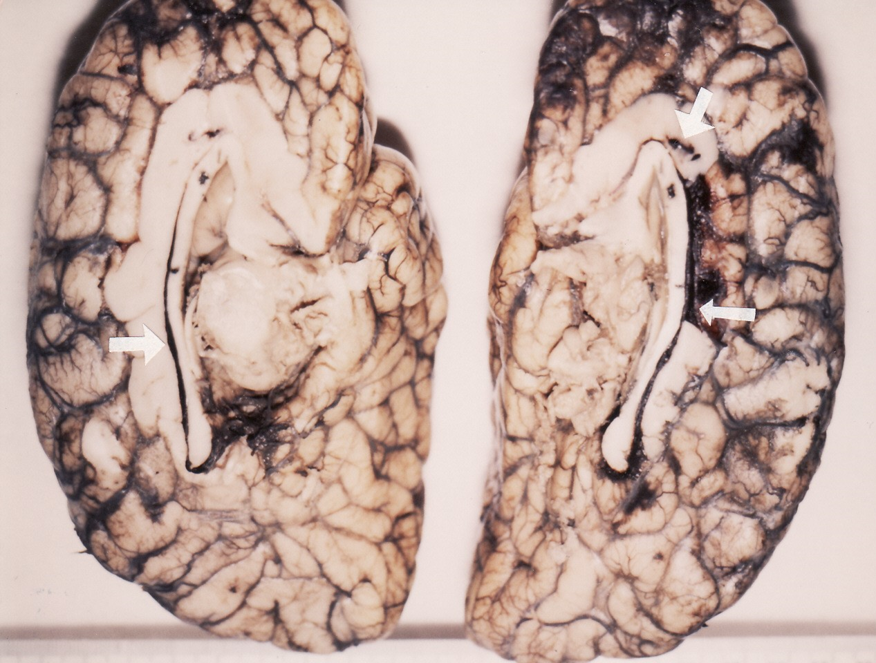 Fig. 4 Formaldehyde-fixed brain hemisections with supracallosal (arrowed) haematoma