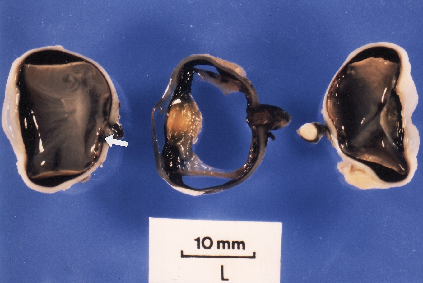 Fig.5 Formaldehyde-fixed eyeball trisection with retinal (arrowed) haemorrhage