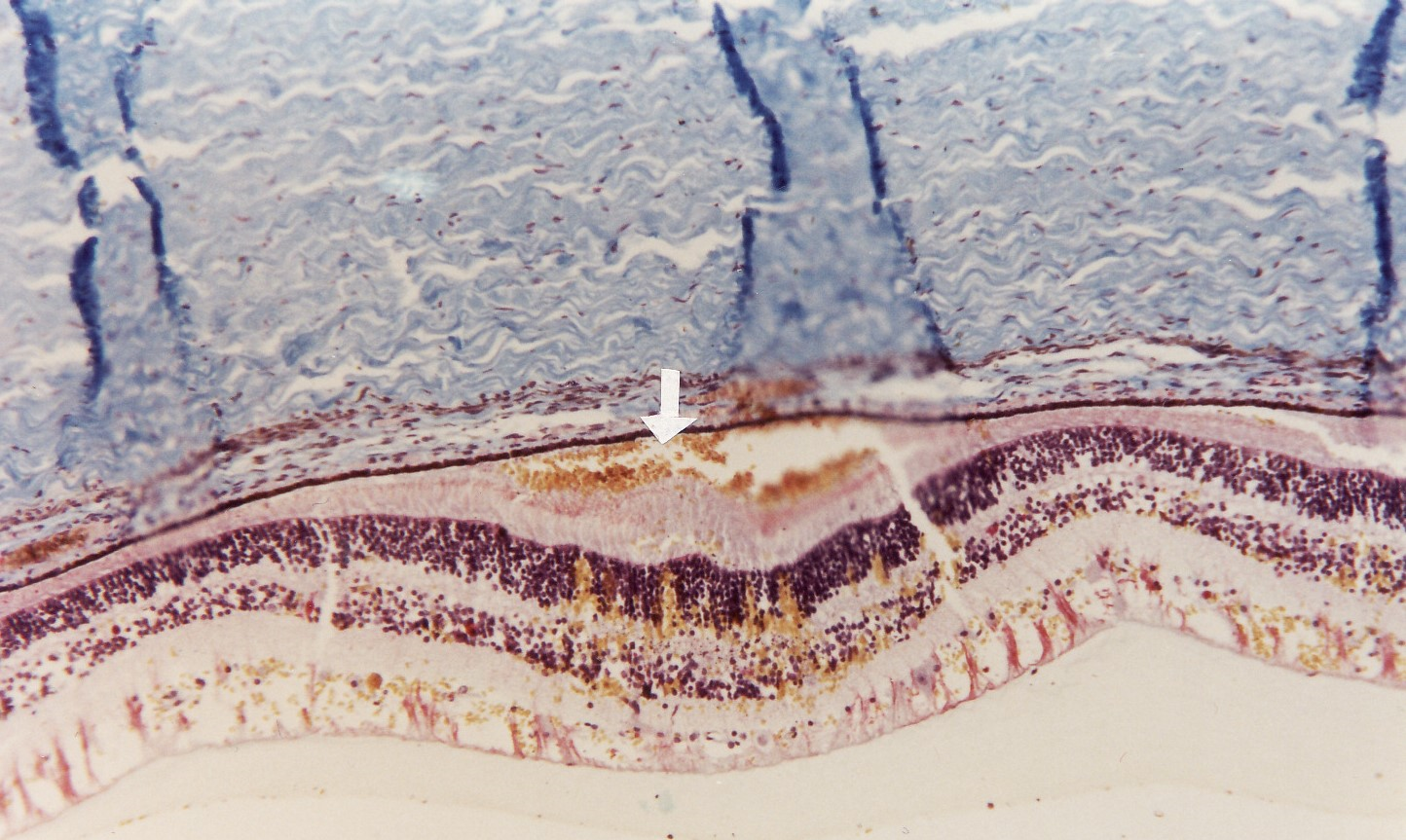 Fig.6 Formaldehyde-fixed eyeball trisection with retinal (arrowed) haemorrhage