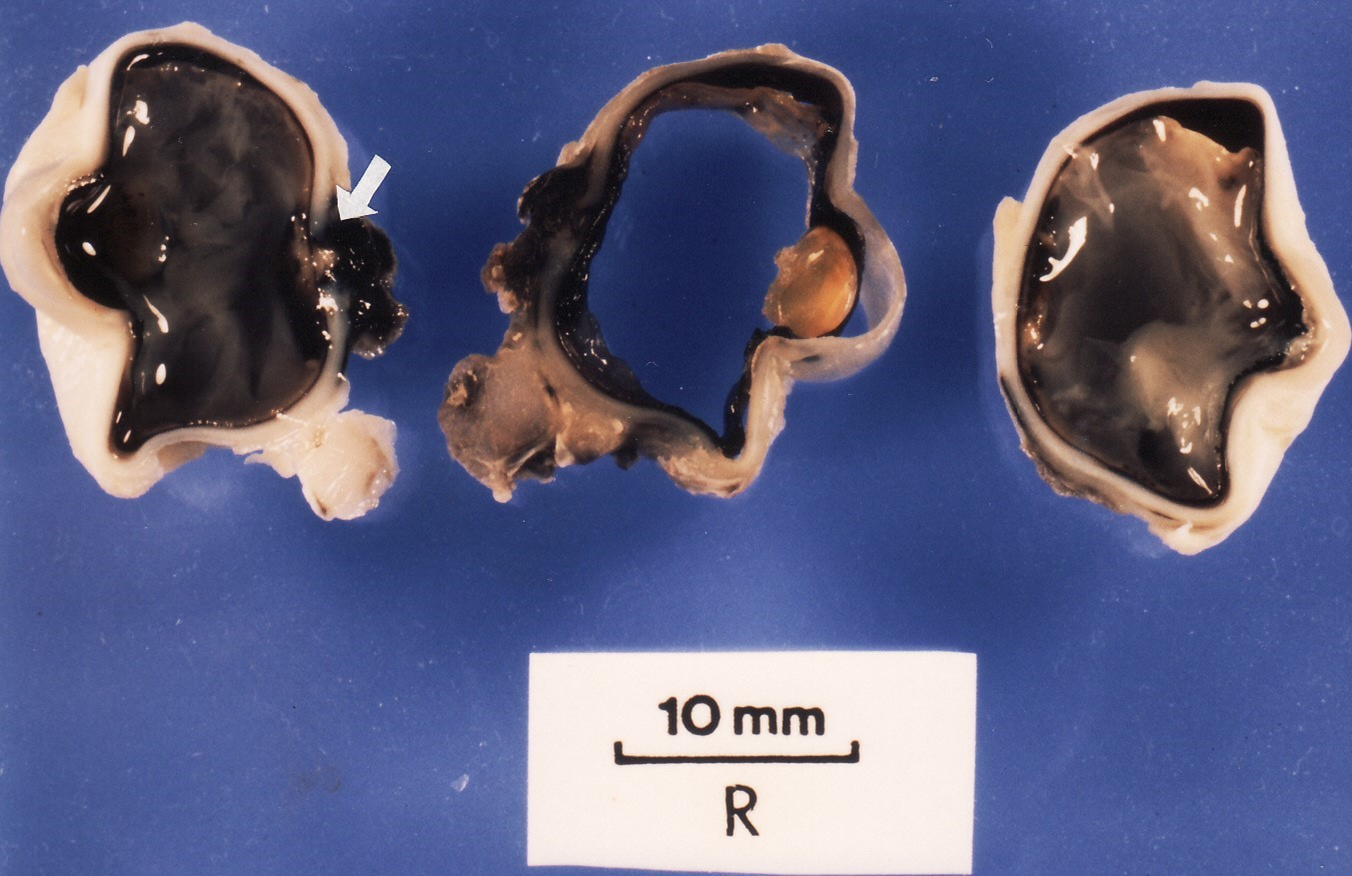 Fig.7 Formaldehyde-fixed eyeball trisection with subhyaloid (arrowed) haemorrhage