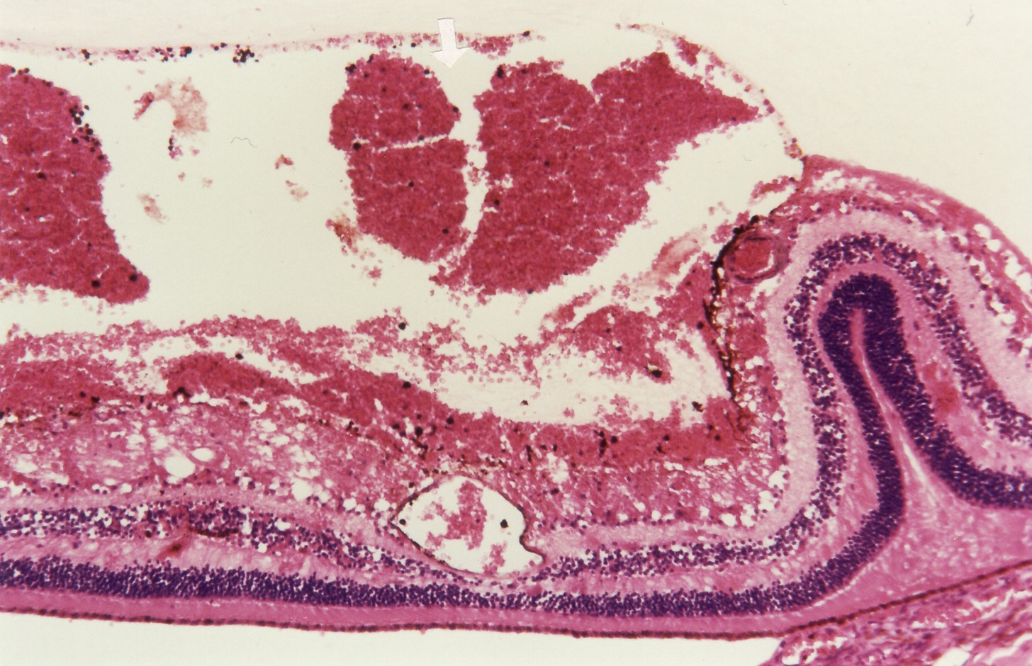 Fig. 8 Micrograph of right eye with subhyaloid (arrowed) haemorrhage (Haematoxylin Eosin x100)