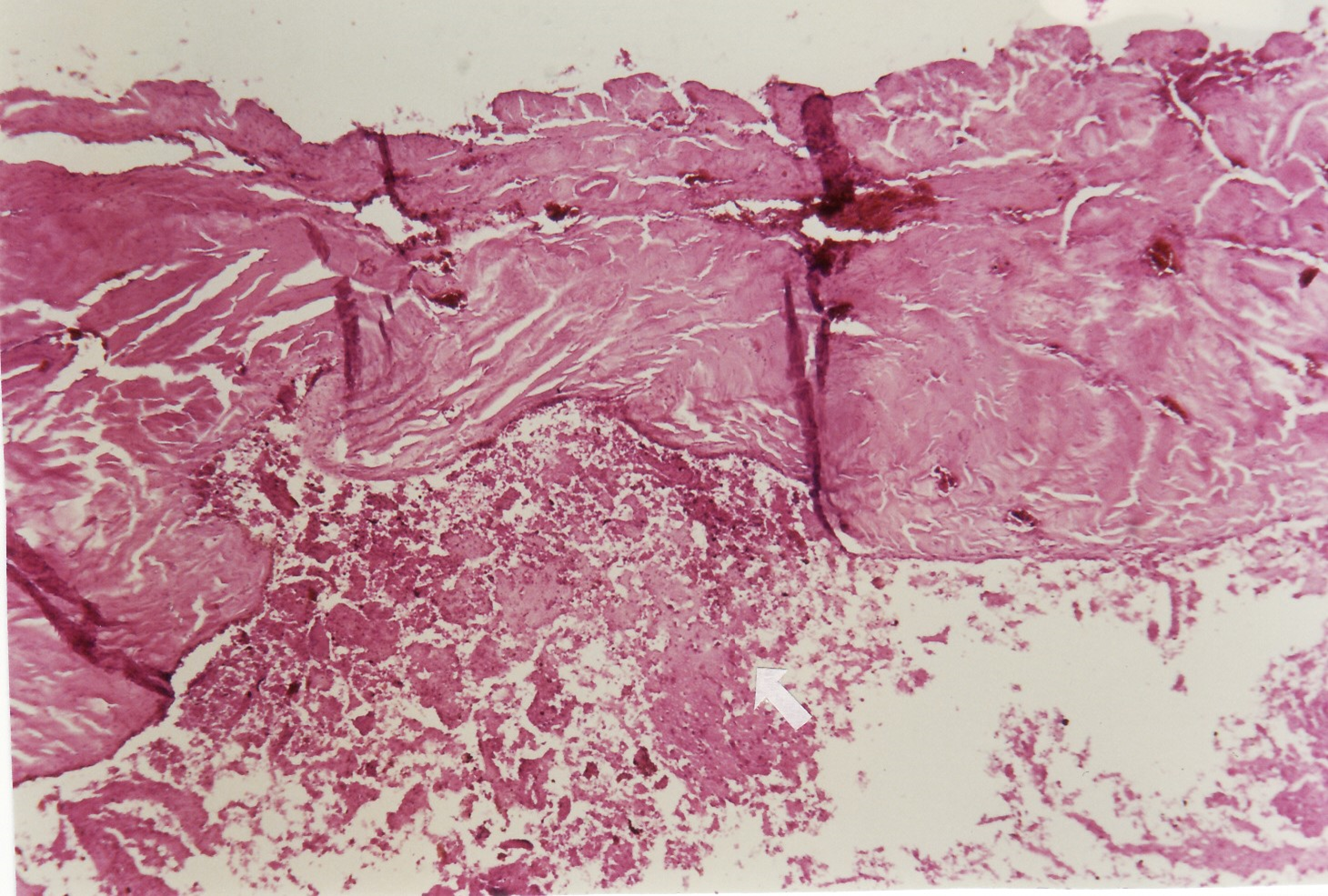 Fig. 9 Micrograph of subdural haematoma (arrowed) with erythrocyte lysis and fibrin ( Haematoxylin Eosin x100)