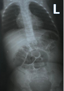 AP radiograph of the chest and abdomen post-removal of stones