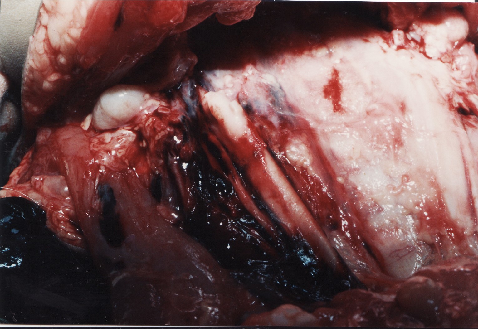Fig. 3 Large diffused iatrogenic contusion around the right jugular vein