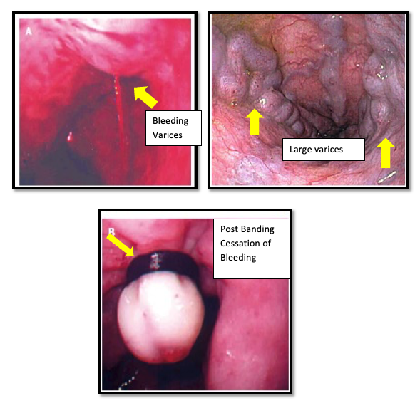 Figure 1: Depicting large Oesophageal Varices with bleeding (Upper images) with immediate cessation of bleeding post banding (lower image).